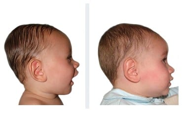 Brachycéphalie bébé de 8 mois