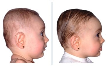 résultats avec doc band bébé bébé brachiocephaly