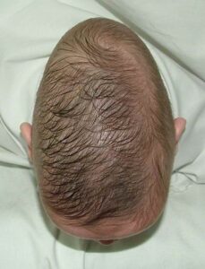 Craniostenose Malformation Congenitale Types De Craniostenose