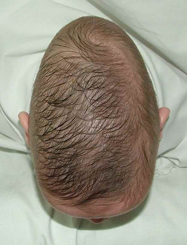 causes craniosténose