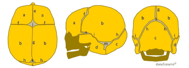Craniosténose